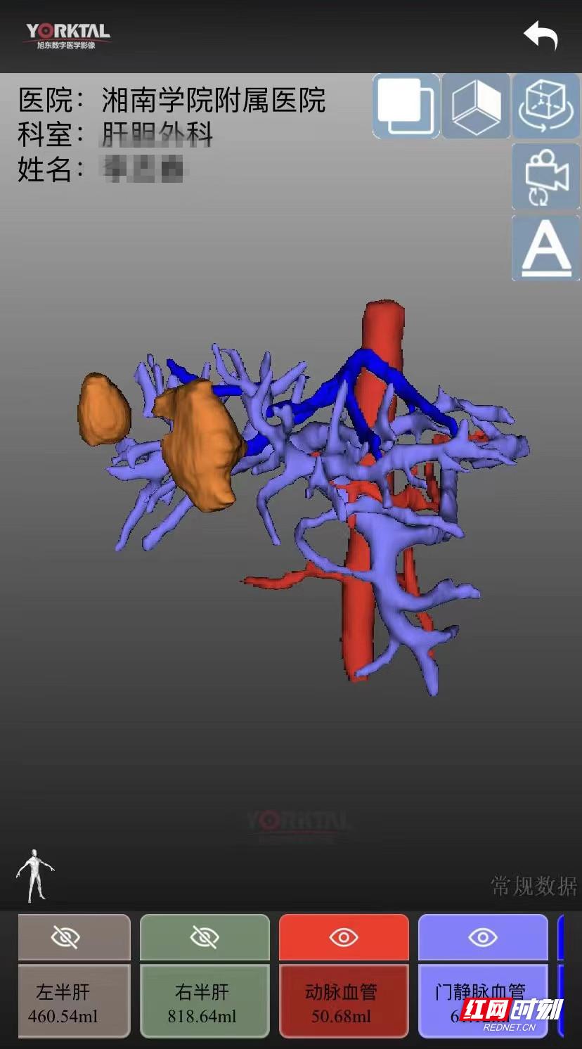 原发性肝癌转化治疗法,为晚期肝癌患者带来福音