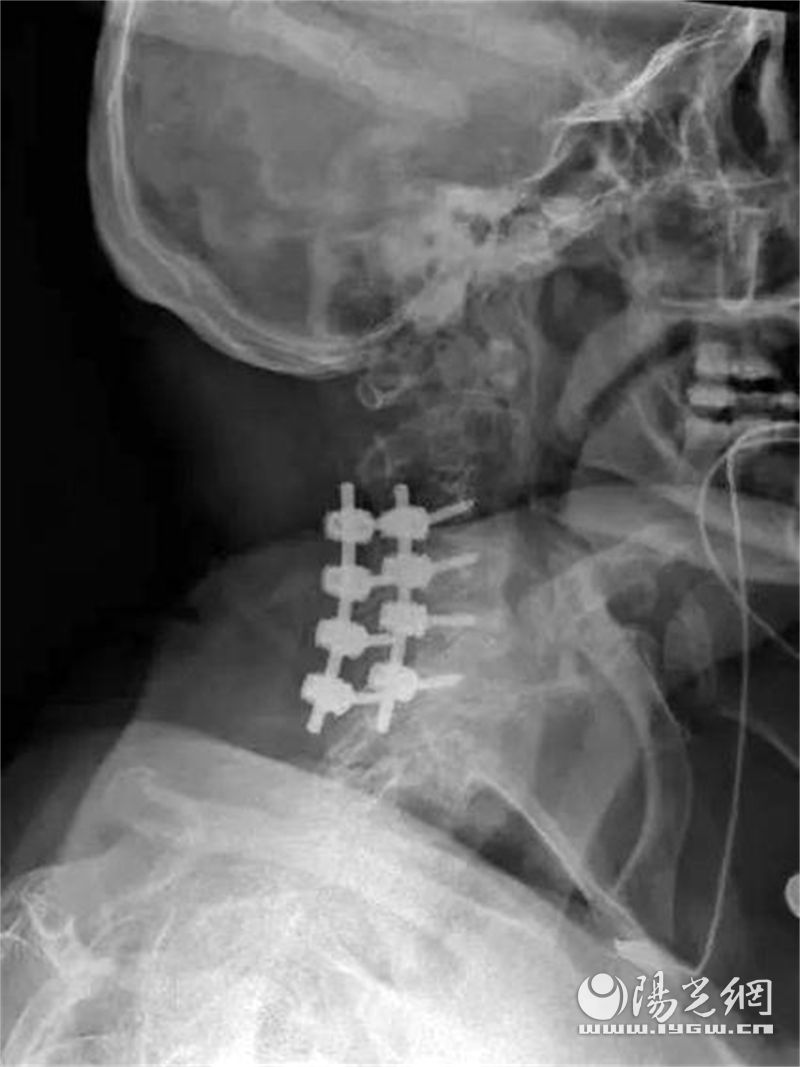 颈椎侧攻螺钉内固定图片,颈椎后路螺钉固定手术是微创吗