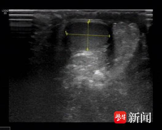 1岁男宝怎么“少个蛋蛋”？医生手术找回来了