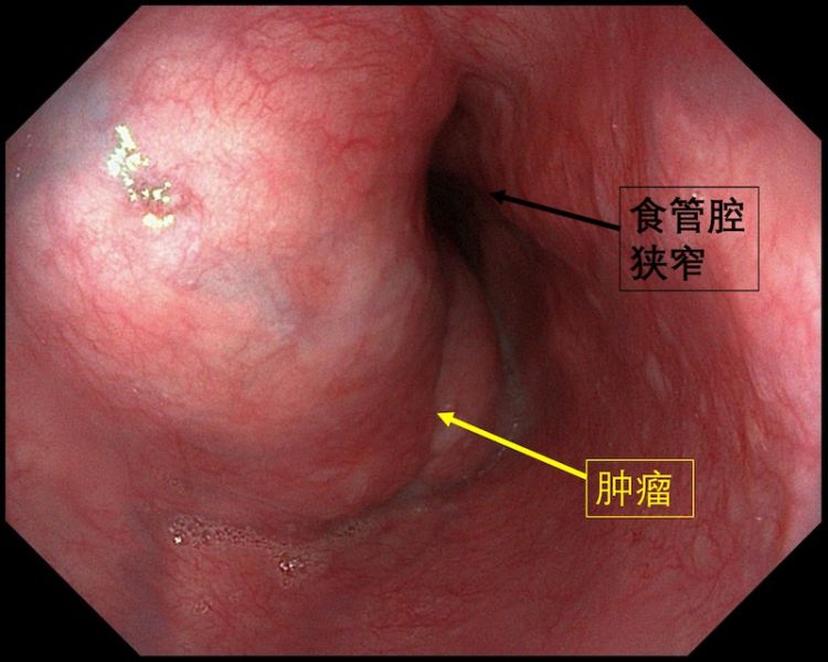 食管长满菜花状肿瘤,食管长个0.5的瘤子需要治疗吗