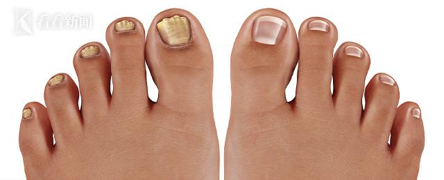 孕期得灰指甲可以擦药吗,孕期得了灰指甲怎么办