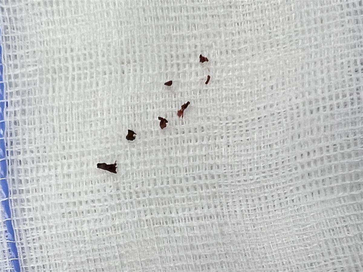 打耳洞上的茶叶梗能消炎吗,耳洞红肿发炎了戴茶叶梗有用吗