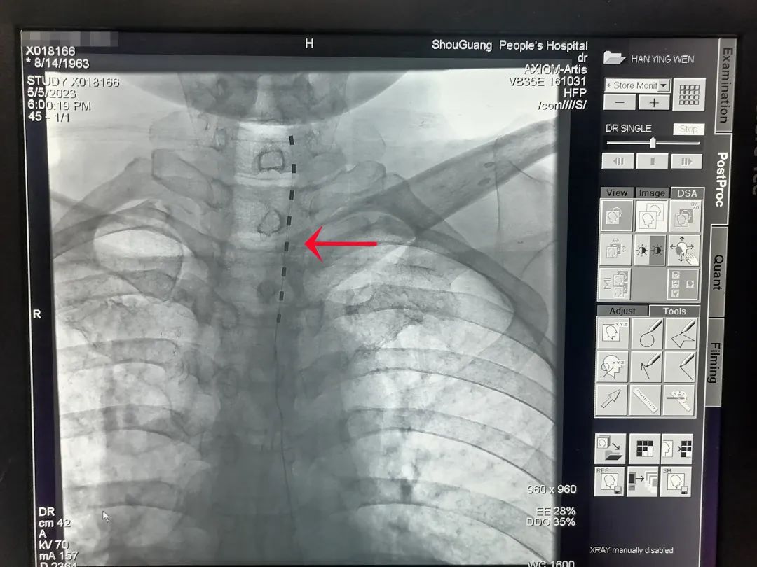 最新技术治疗中枢神经,中枢靶控镇痛术