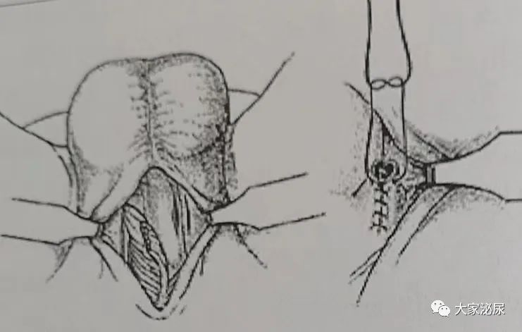 干货│缺血型阴茎异常勃起的治疗