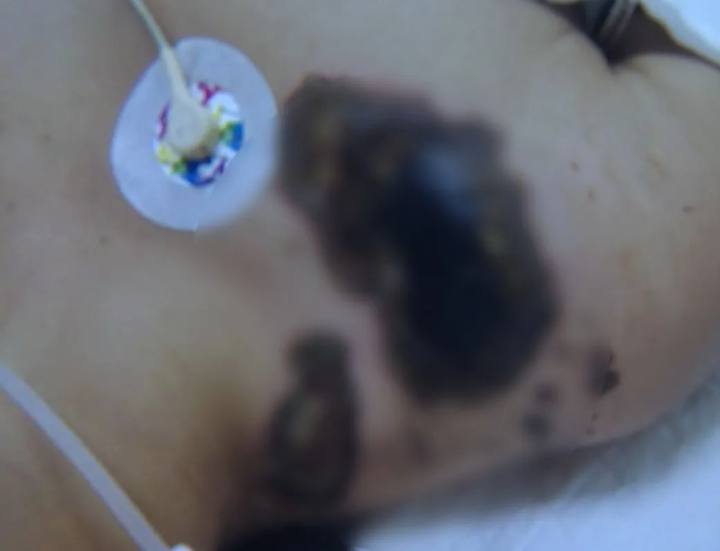 充电玩手机遭电击女孩面临截肢,玩苹果手机充电被电击面临截肢