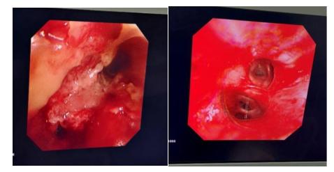 内镜下良性肿瘤切除术,手术切除恶性肿瘤的正确方法