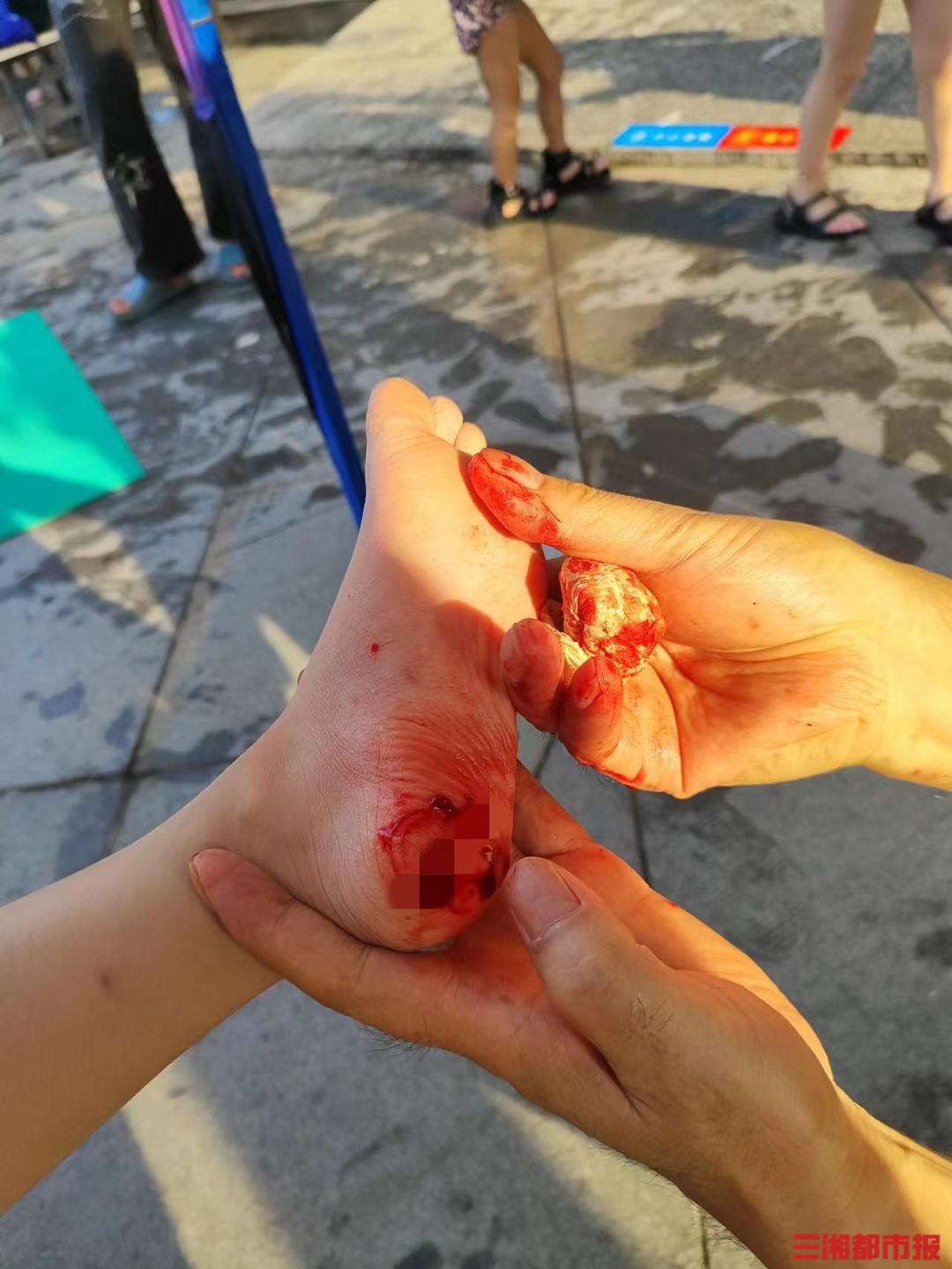 315闪耀我守护我｜水上乐园滑梯水池暗藏玻璃片，5岁女童脚丫被割破缝针