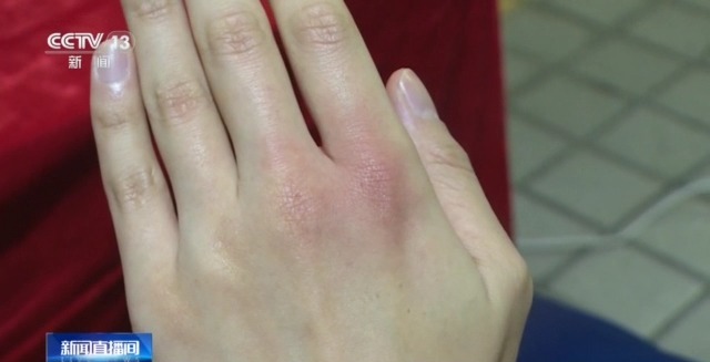 取暖设备使用不当,保暖神器真的会导致低温烫伤吗