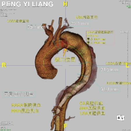 主动脉夹层血管腔内修复术,动脉夹层修复术